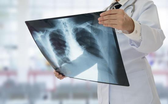  Trasplantan los dos pulmones a italiano de 18 años que contrajo la COVID-19