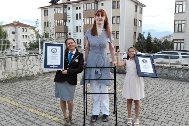  Qué es el síndrome de Weaver, la condición que afecta a la mujer más alta del mundo