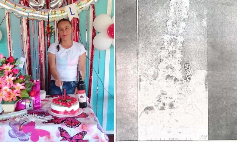  Aguja e hilo alberga en su vientre una mujer desde hace 10 años tras una cirugía de parto